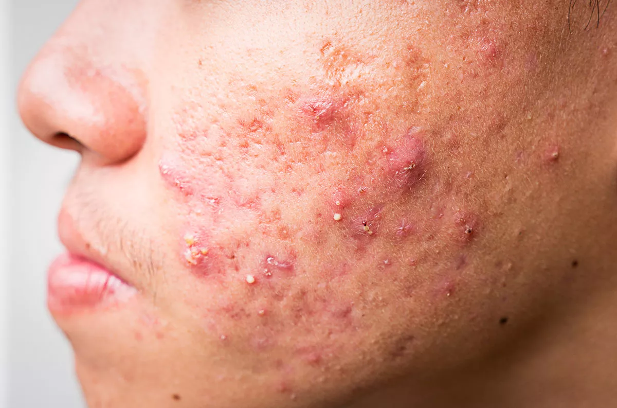 Curcumin for acne vulgaris: a natural anti-inflammatory and antimicrobial breakthrough